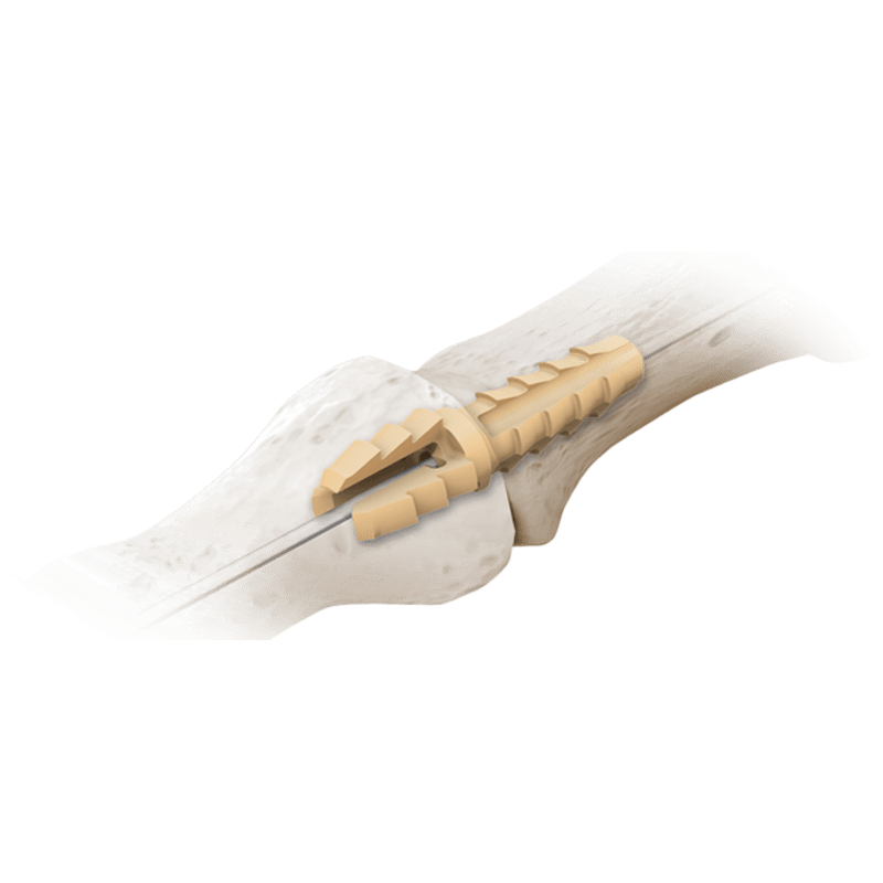 DuaFit® PIP Implant